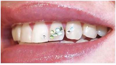 Tooth Gems  Pearly Whites