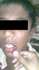 The 10-year-old boy sustained a number of injuries, including a burst lip, following the beating from his older brother.