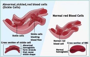 sickle cell copy 2