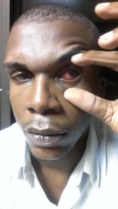 Selwin Atwell’s eye after he was beaten in prison.