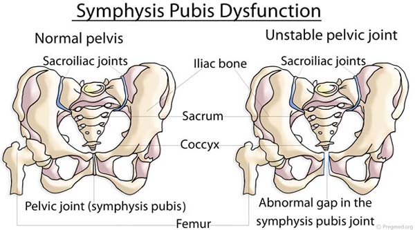 pelvic