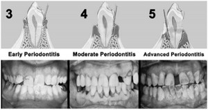 peridontis