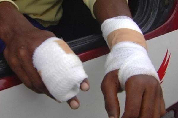 The injuries on Campbell’s hands.