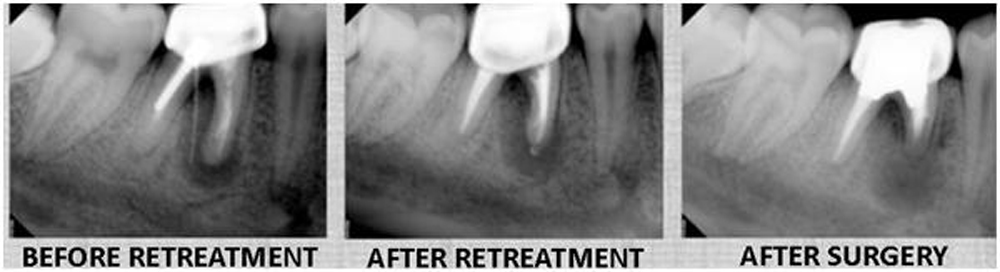 dental-health-root-canal-failures-kaieteur-news