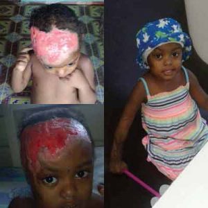 Renia Rogers as these photos bear out still needs corrective surgery