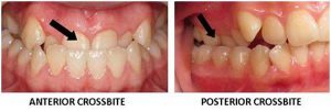 crossbite