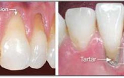 DENTAL HEALTH…GINGIVAL RECESSION