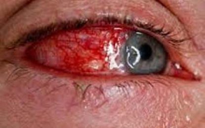 Health Ministry notes increased cases of ‘red eye’