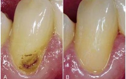 DENTAL HEALTH…GLASS IONOMER RESTORATIVE MATERIALS