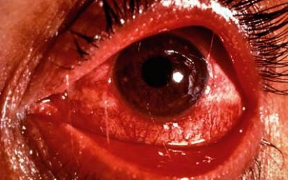 CARPHA issues ‘Red Eye’ alert for Region