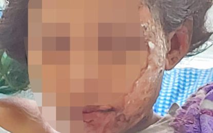 Mother of two burnt with hot porridge