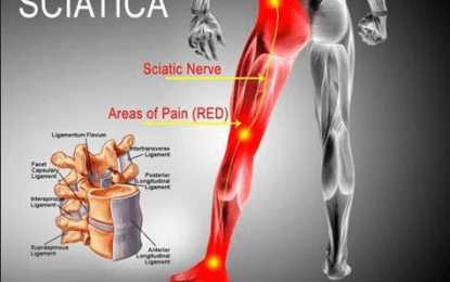 Sciatica: The showstopper for anyone on the go