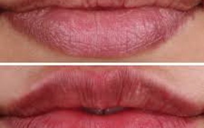 How to Get Rid of Chapped Lips – My 5 Easy Hacks