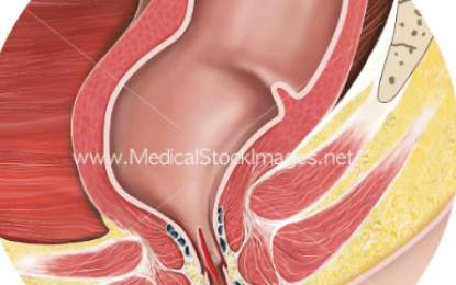 Anal Fissures: It’s painful and often mistaken for hemorrhoids