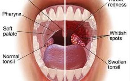 Sore Throat: Knowing when it’s dangerous