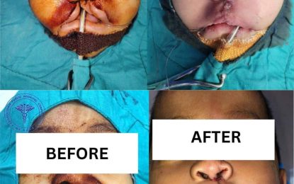 Five successful cleft surgeries done at GPHC