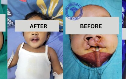 GPHC local Smile Train Team performs 7 successful cleft surgeries