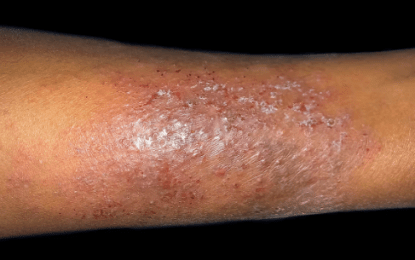 Common causes of skin disorders