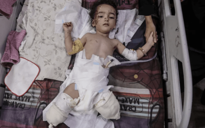 Gaza toddlers got the polio vaccine, then an Israeli bomb took their legs