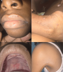 Suspected outbreak of Hand, Foot and Mouth Disease in Region Four ---samples sent to CARPHA for  confirmation