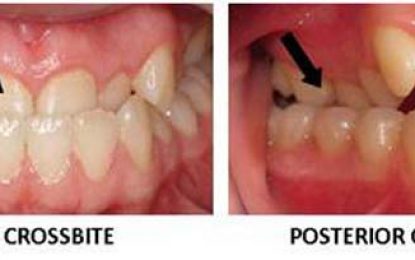 Dental Health….CROSSBITE
