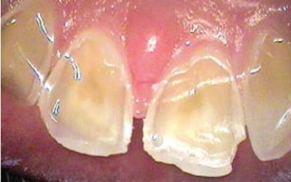 DENTALHEALTH….EFFECTS OF EATING DISORDERS ON ORAL HEALTH