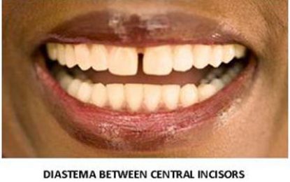 DENTAL HEALTH….DIASTEMA – Gaps BetweenTeeth