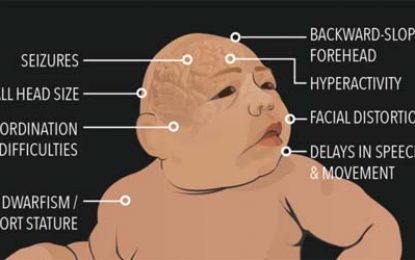 Guyana getting support to deal with worrying Microcephaly