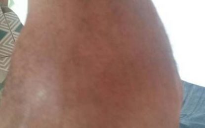 Suspect in alleged stabbing of Lethem Police says ranks assaulted him