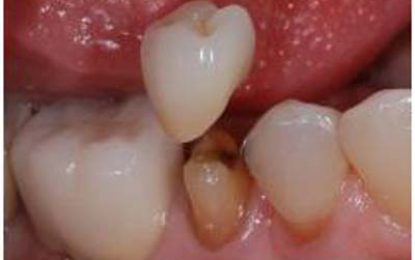 DENTAL CROWNS