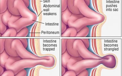 Hernias: What you need to know about them