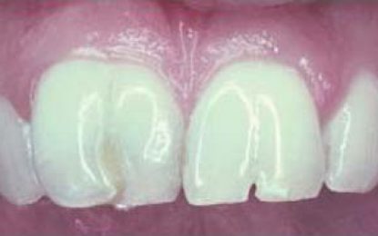 DENTAL HEALTH….EMBRYOLOGICAL STAGES OF TOOTH DEVELOPMENT