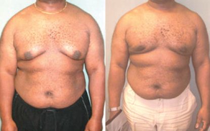 Four male breast cancer patients receiving treatment in Guyana