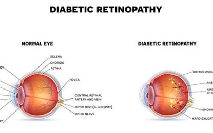 Helping to save your vision
