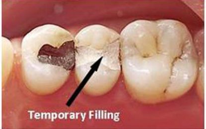 DENTAL HEALTH…TEMPORARY FILLINGS
