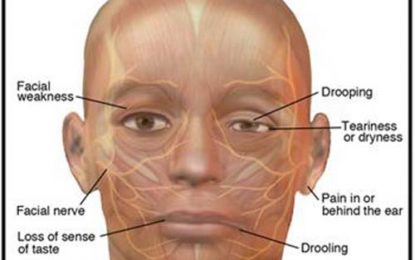 DENTAL HEALTH…BELL’S PALSY