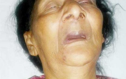 Thieves escape with granny’s gold-plated teeth after brutal beating