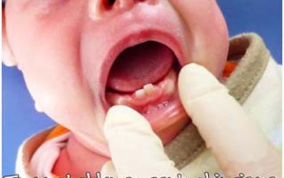 DENTAL HEALTH…NATAL AND NEONATAL TEETH