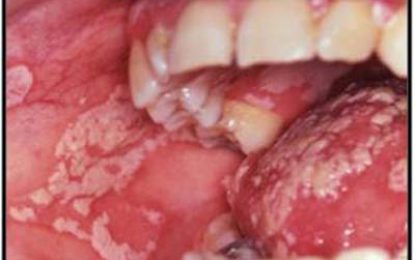 ORAL CANDIDIASIS – Thrush