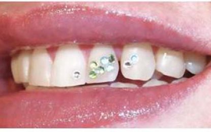 TOOTH JEWELLERY – BLINGING UP THE PEARLY WHITES