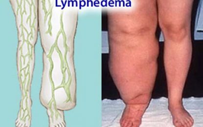 PAHO takes filaria fight to Region Ten