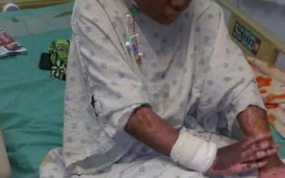 Burnt Charity teen on slow road to recovery