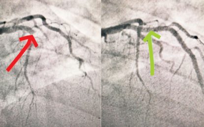 Essequibo man gets free life-saving cardiac care at GPHC