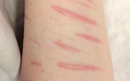 Self harm surveillance project helping to reach those prone to suicide