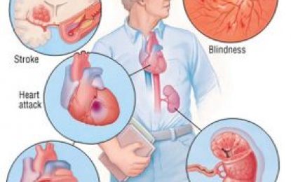 Important facts about Hypertension (high blood pressure)