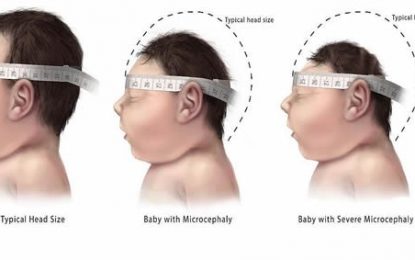 Public health sector better positioned to care for microcephaly babies  — 17 being afforded rehabilitation and paediatric care
