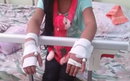 Burn patients at GPHC to receive counseling