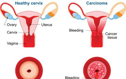 Cervical Cancer Killing Slowly