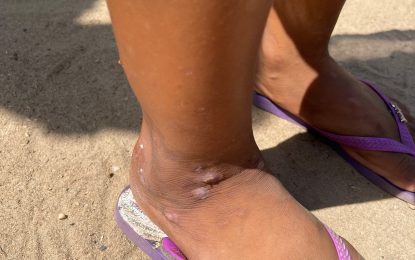 Internal parasite infection prevalent among children in Central Mazaruni