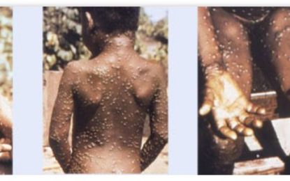 Nurses in Guyana worried about potential Monkeypox outbreak